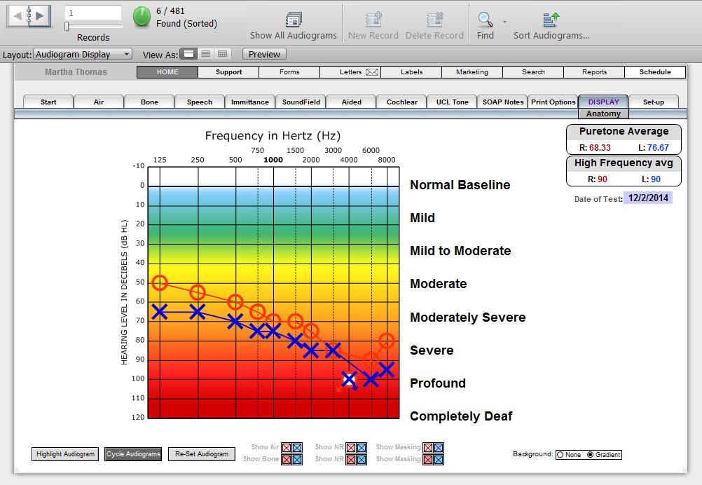 Audiogram Display - Audiograms